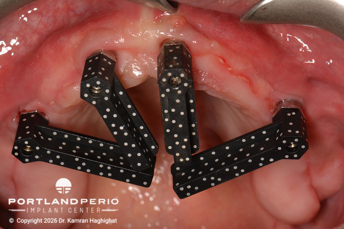 Restoring Hope: Comprehensive All On 4 Full Arch Rehabilitation - Dr. Kamran Hagighat - Portland Perio Implant Center  |  Portland, OR
