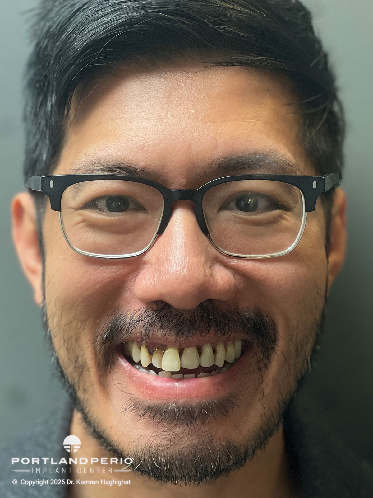 Restoring Hope: Comprehensive All On 4 Full Arch Rehabilitations - Portland Perio Implant Center - Dr. Kamran Haghighat