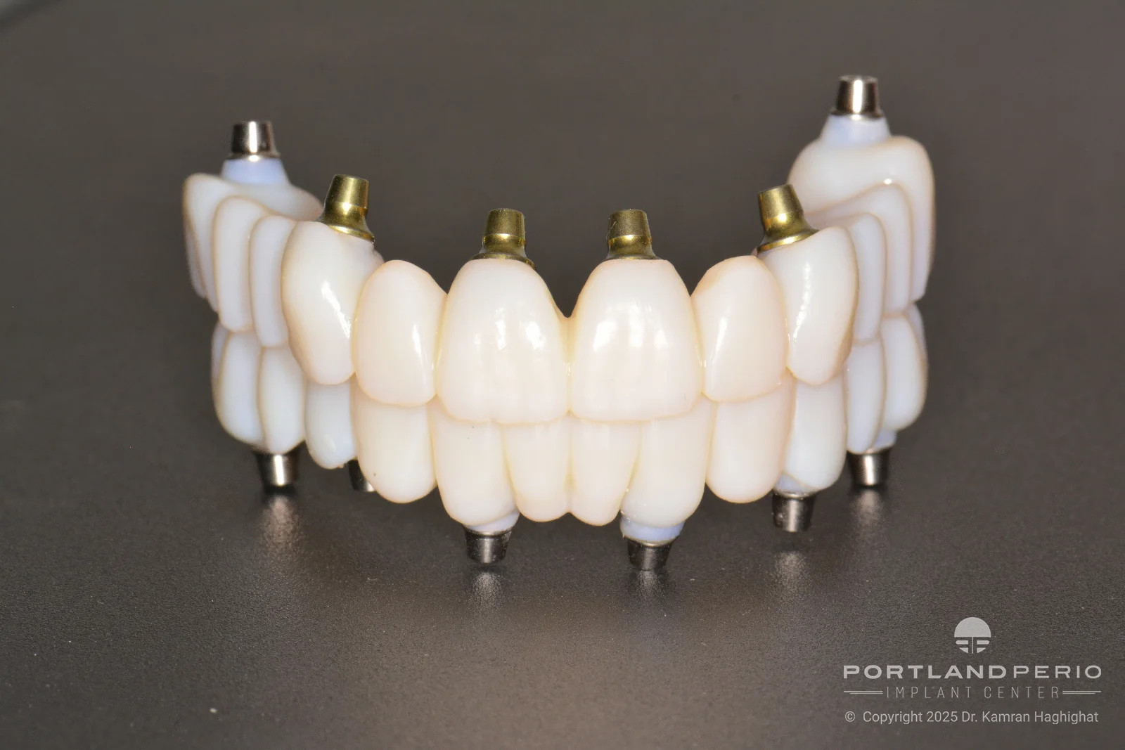FP1 Prosthesis: A Bone Preserving Alternative To All On 4 Dental Implants - by Dr. Kamran Hagighat - Portland Perio Implant Center - Portland, OR